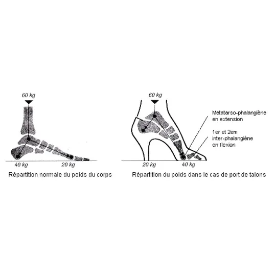 Epitact Barrettes Sous Diaphysaires pour Orteil en Marteau ou en Griffe Taille S