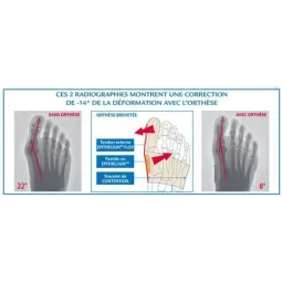 Epitact Orthese Corrective Double Hallux Valgus et Douleurs Plantaires Taille L Droit