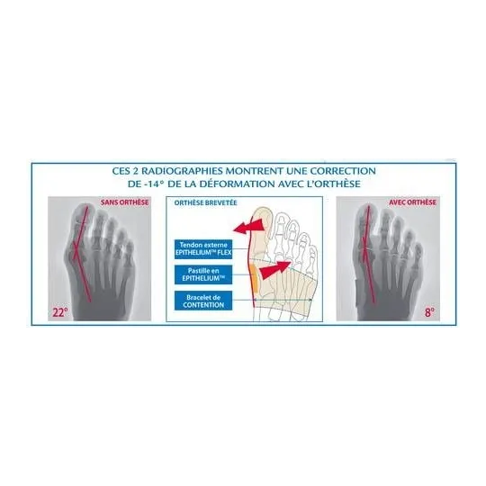 Epitact Orthese Corrective Double Hallux Valgus et Douleurs Plantaires Taille L Droit Epitact Orthese Corrective Double Hallux Valgus et Douleurs Plantaires Taille L Droit