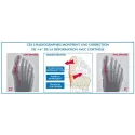Epitact Orthese Corrective Double Hallux Valgus et Douleurs Plantaires Taille M Droit Epitact Orthese Corrective Double Hallux Valgus et Douleurs Plantaires Taille M Droit