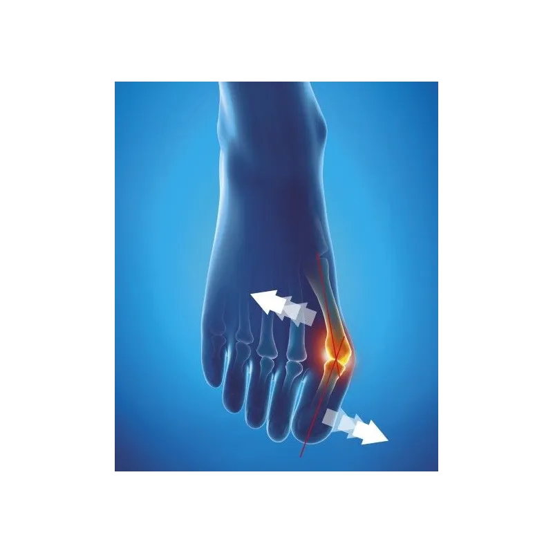 Epitact Orthèse Corrective Souple Hallux Valgus