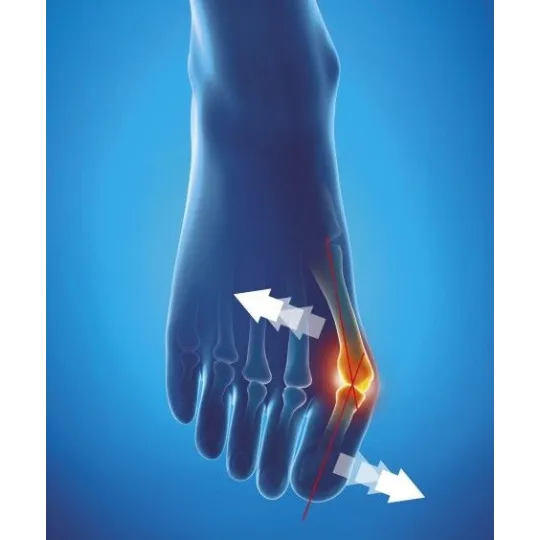 Epitact Orthèse Corrective Souple Hallux Valgus Epitact Orthèse Corrective Souple Hallux Valgus